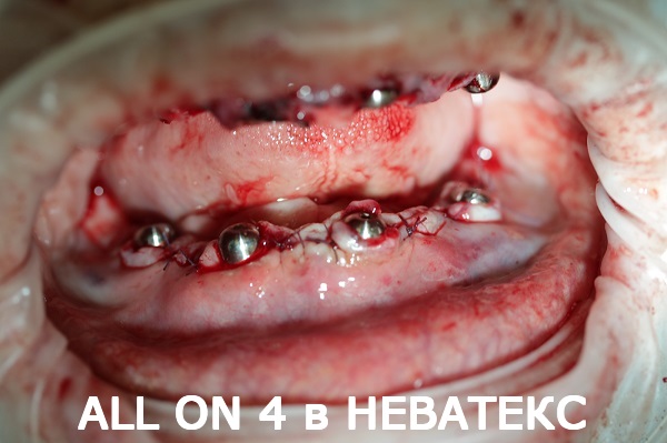 all on 4 фото во время имплантации в неватекс all on 4 фото во время имплантации